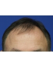Before Hair Transplant &nbsp;Front